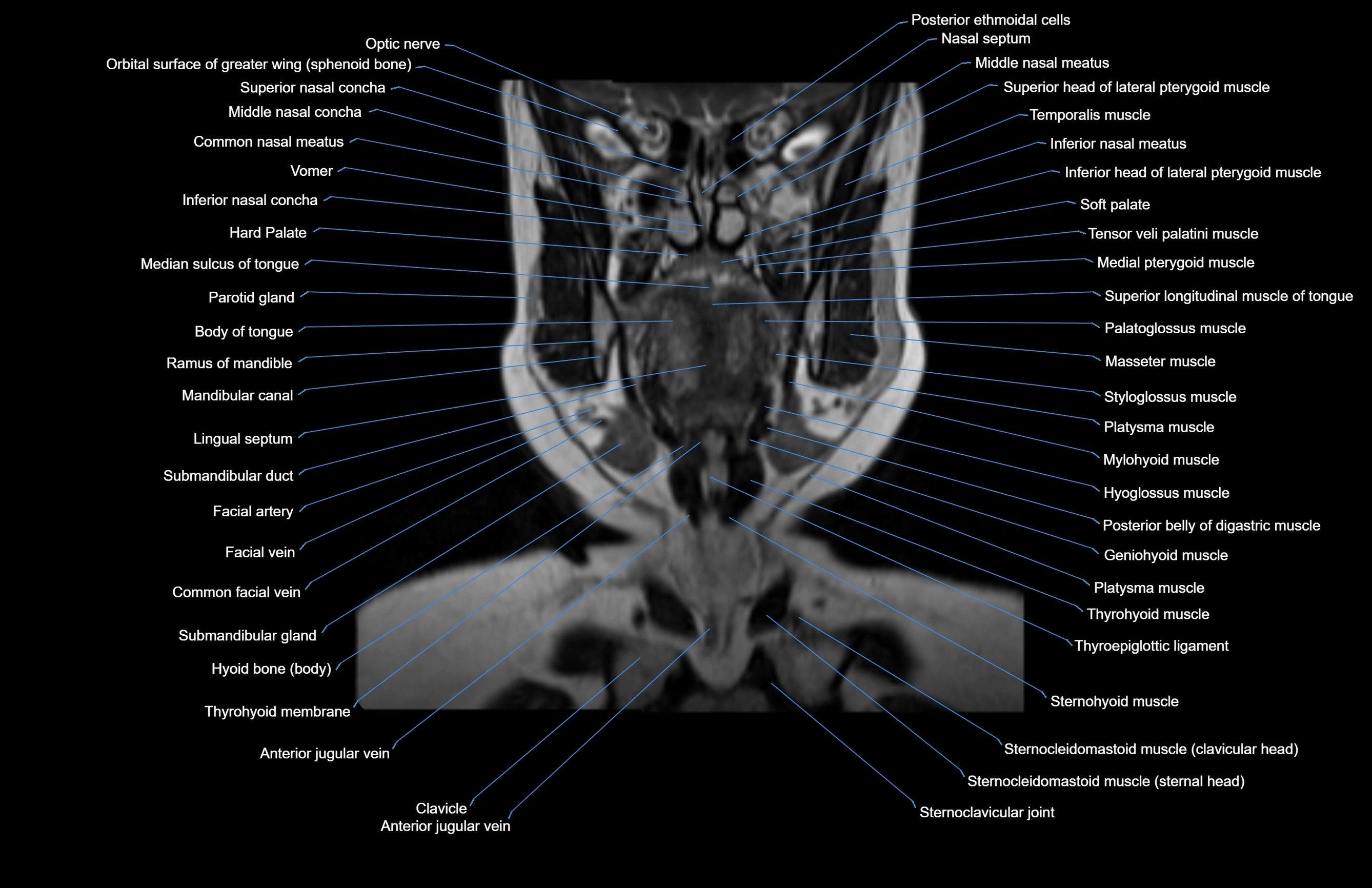 Neck coronal cross sectional MRI anatomy 3T MRI  image-img-00001-00051.webp